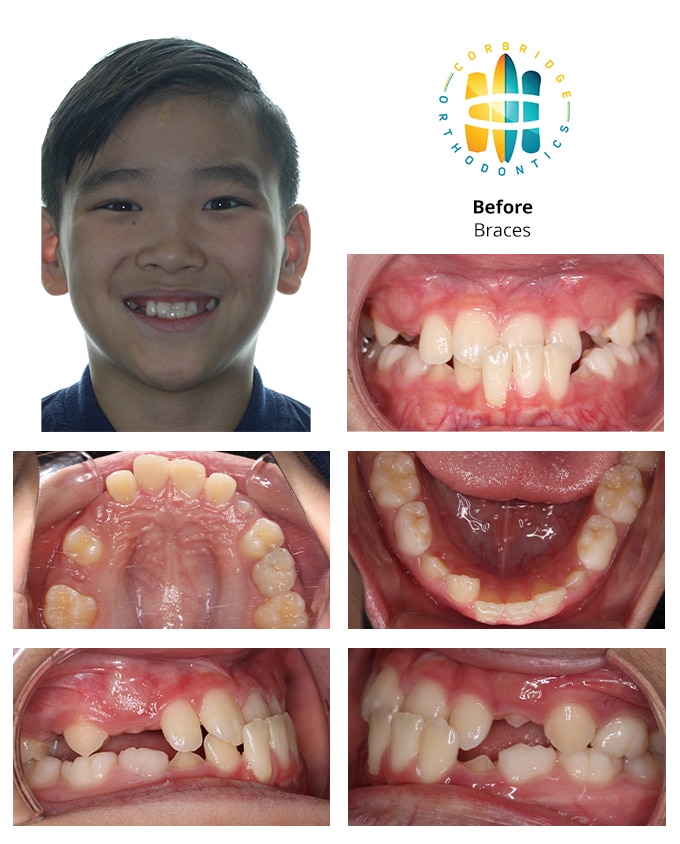 Before And After Orthodontic Treatment Corbridge Orthodontics
