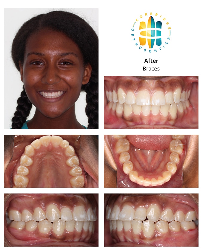 Braces Before And After Jawline