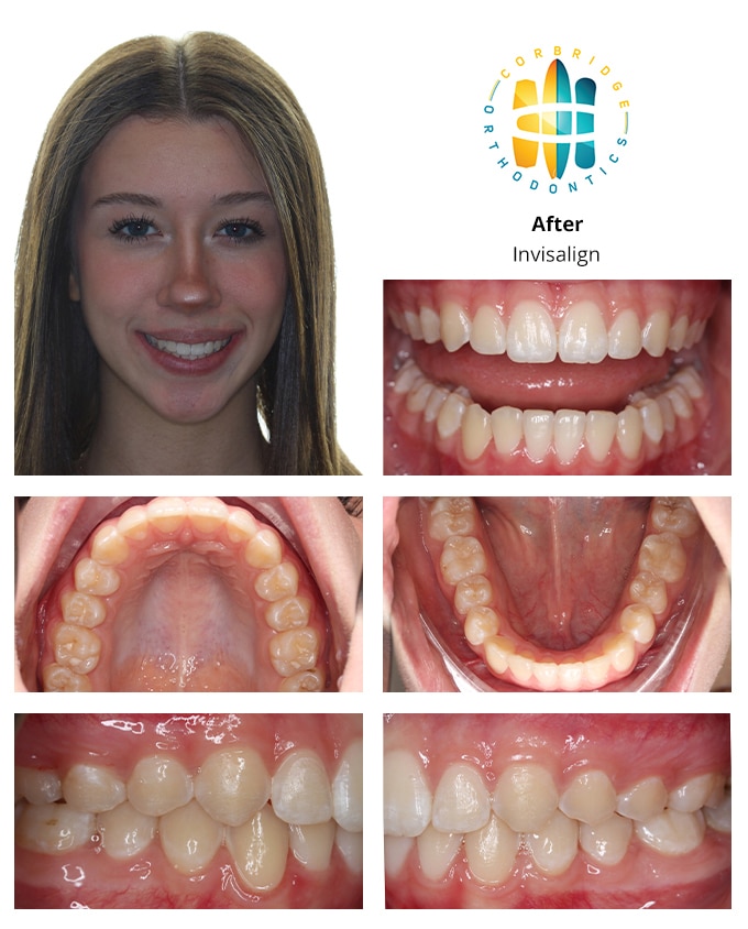 Before and After orthodontic treatment
